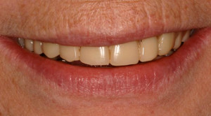 photo_custom-denture-1