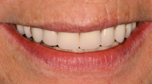 photo_custom-denture-2